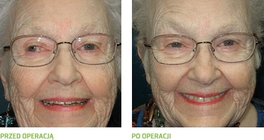 Porównanie wyglądu osoby dorosłej przed i po operacji zeza